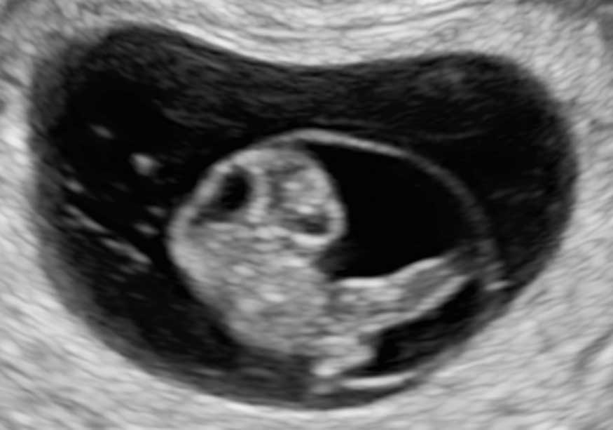 9 what to week ultrasound expect at Week 9