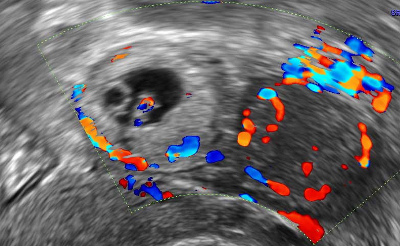 When an Ultrasound Shows a Heartbeat in Early Pregnancy